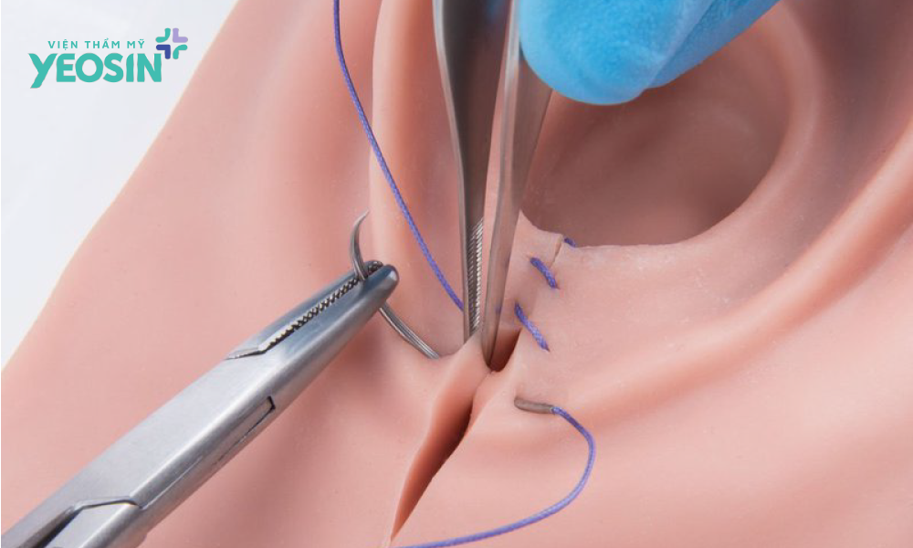 Chỉ tự tiêu được sử dụng trong phục hồi tầng sinh môn