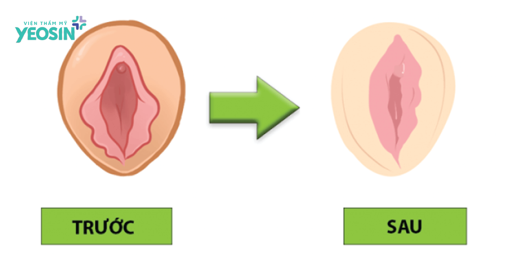 Thu hẹp vùng kín thực chất là gì
