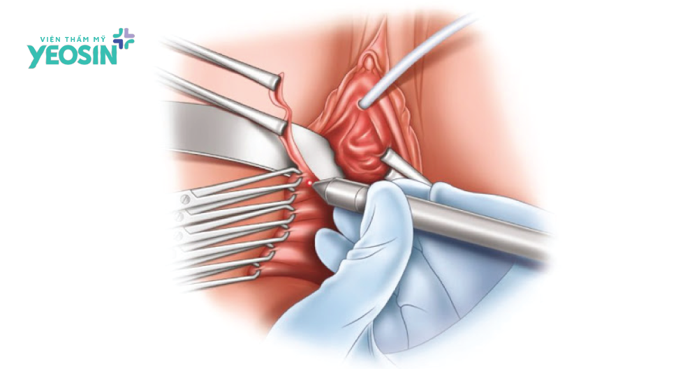 Thu hẹp vùng kín bằng Laser