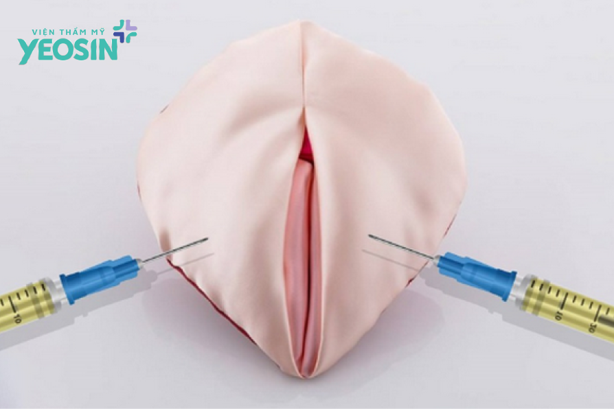 Làm đầy môi lớn là gì?