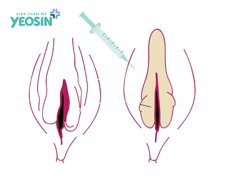 tiêm filler môi lớn