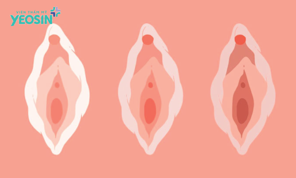 Vùng kín sau sinh bị giãn nở