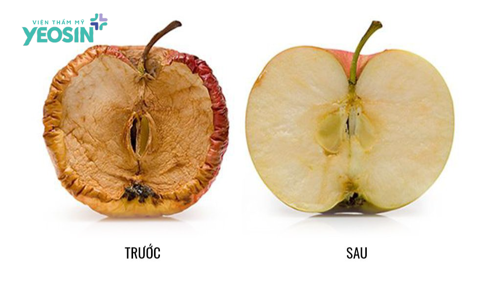 Làm đầy môi lớn giúp cải thiện tình trạng khô hạn