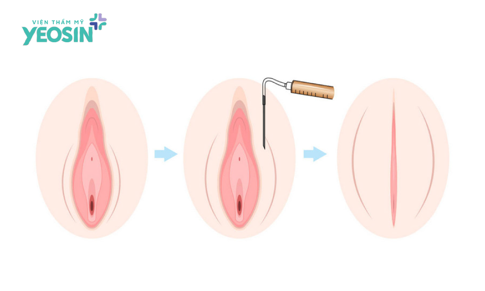 Cấy mỡ tự thân - Trẻ hóa tổng thể thay vì chỉ se khít âm đạo