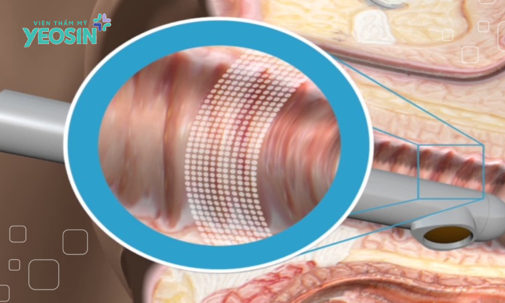 Công nghệ Laser trong se khít vùng kin·