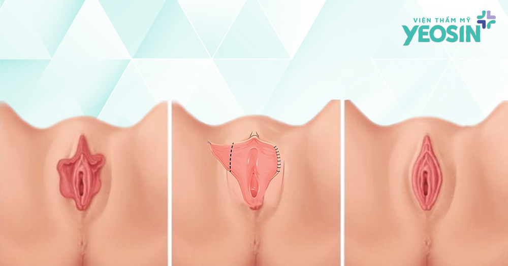 Phẫu thuật thu nhỏ môi bé