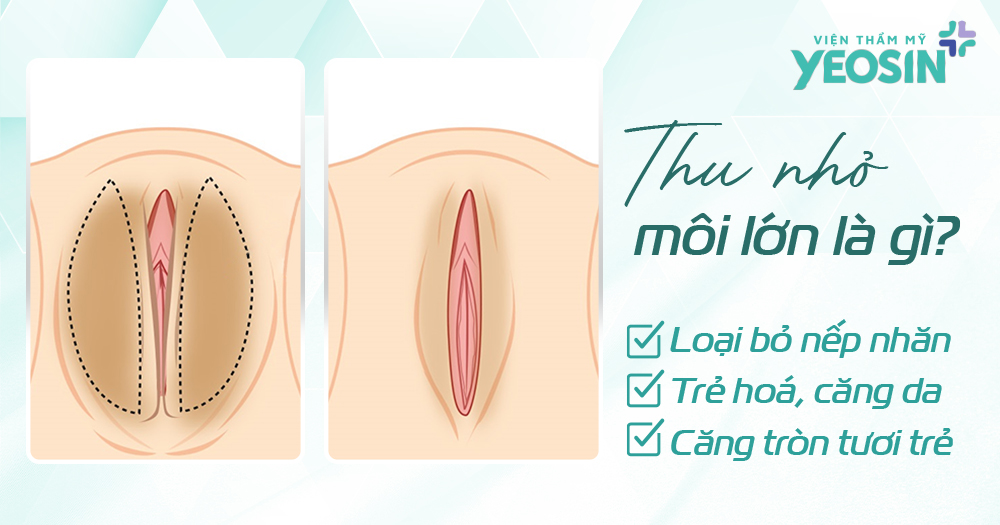 Thu nhỏ môi lớn vùng kín là gì