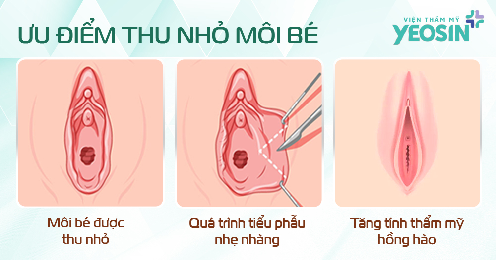 Ưu điểm nổi bật khi làm thu nhỏ môi bé vùng kín