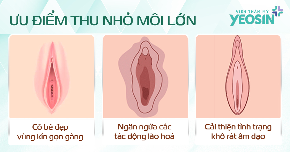Ưu điểm vượt trội của dịch vụ phẫu thuật thu nhỏ môi lớn