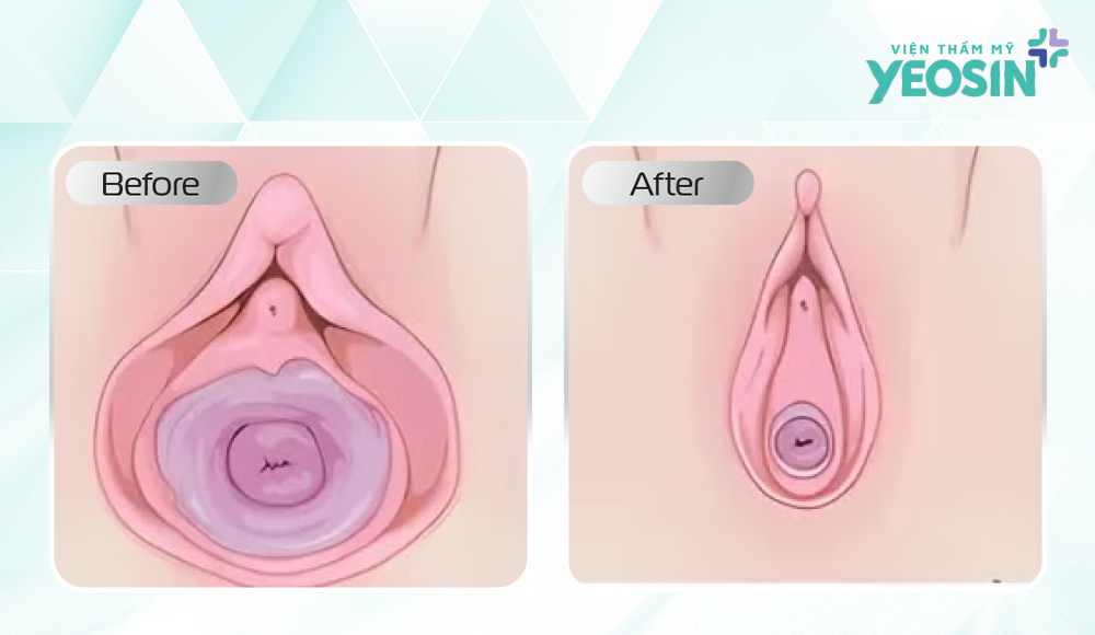 Ưu điểm vượt trội của công nghệ tái tạo tầng sinh môn sau sinh