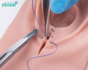 Tái tạo tầng sinh môn sau sinh