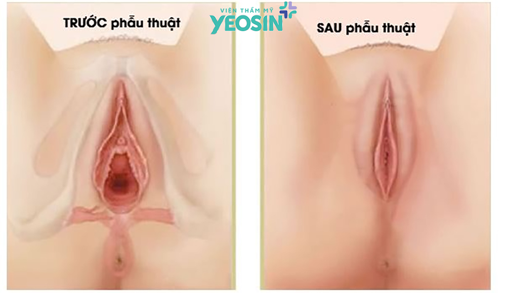 Ưu điểm vượt trội của công nghệ tái tạo tầng sinh môn sau sinh