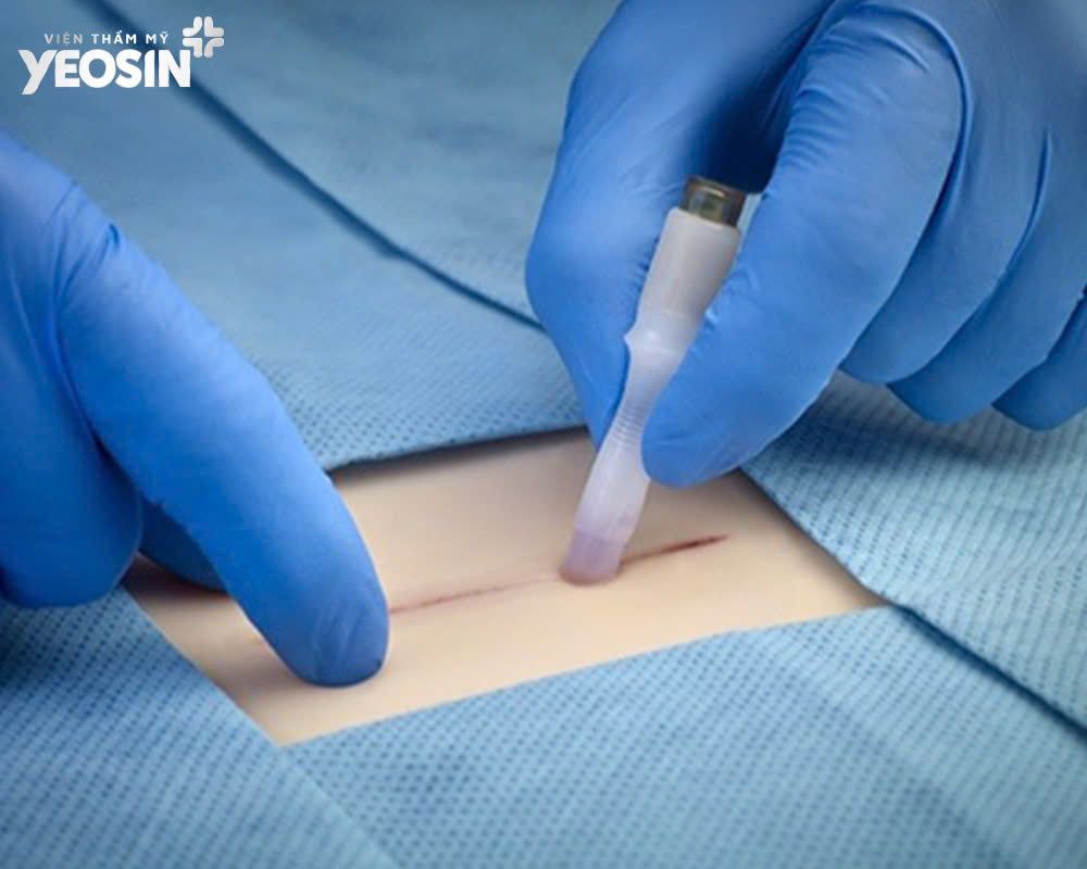 Tái tạo tầng sinh môn sau sinh