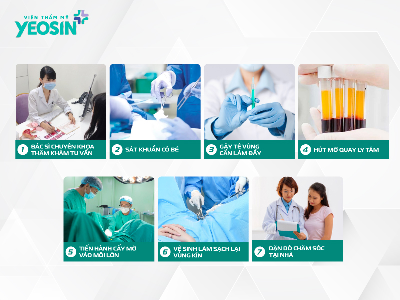 Quy trình cấy mỡ tự thân làm đầy môi lớn tại Viện Thẩm Mỹ Yeosin