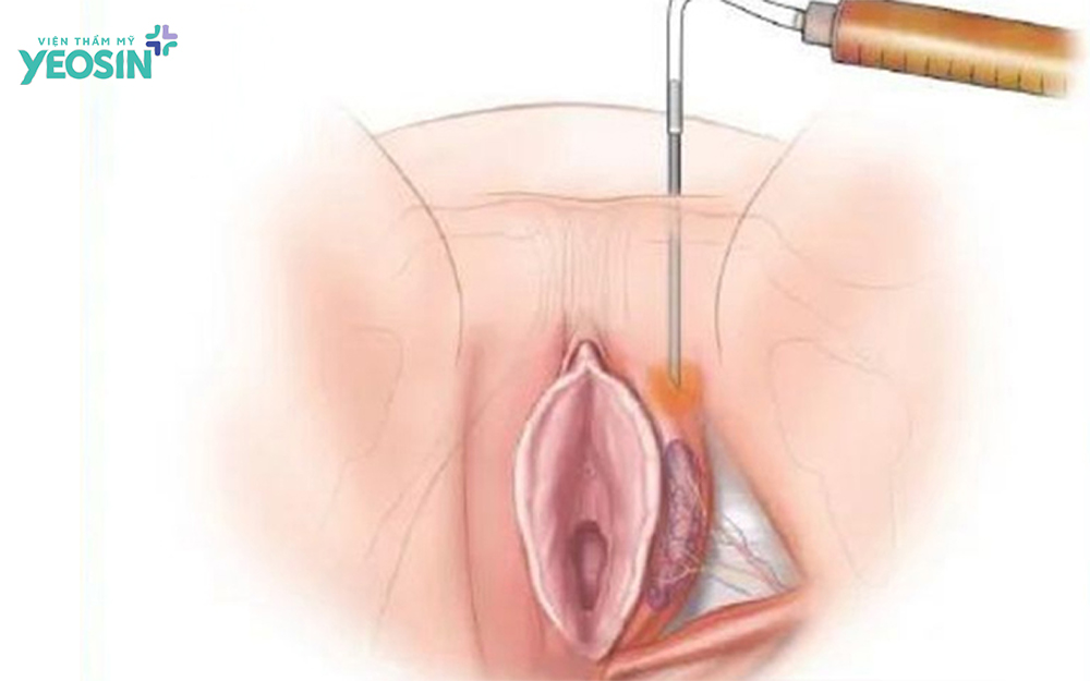 Cơ chế hoạt động của công nghệ cấy mỡ tự thân làm đầy môi lớn