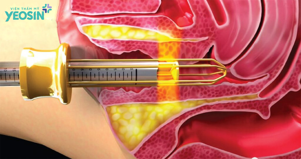 Quy trình trẻ hóa âm đạo bằng công nghệ vi điểm tại Viện Thẩm Mỹ Yeosin