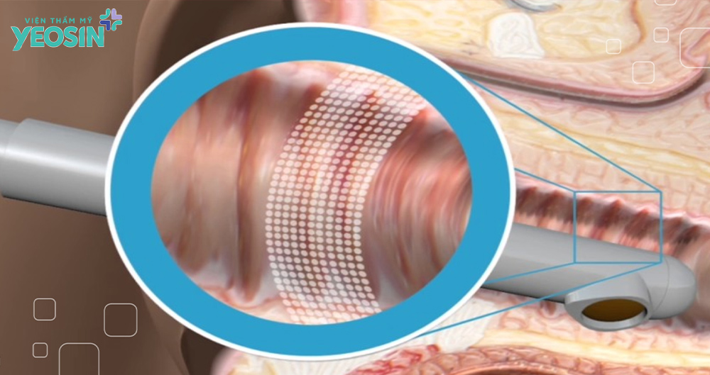 Cơ chế hoạt động của công nghệ vi điểm trẻ hóa âm đạo