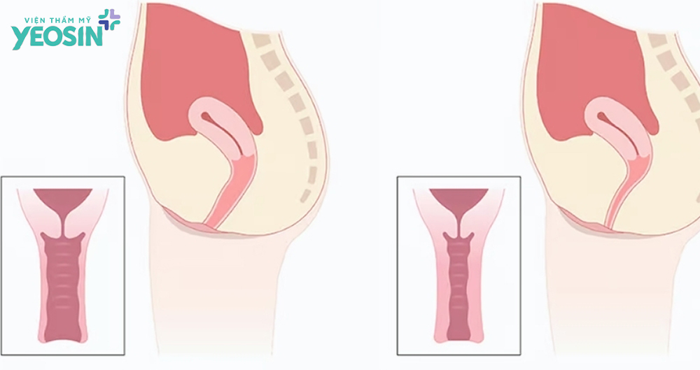 trẻ hóa âm đạo