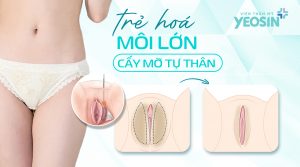 Chi phí cấy mỡ vùng kín giá bao nhiêu - Bảng giá trẻ hóa vùng kín